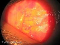 Clinical ophthalmic photograph of conjunctival laceration - trauma condition