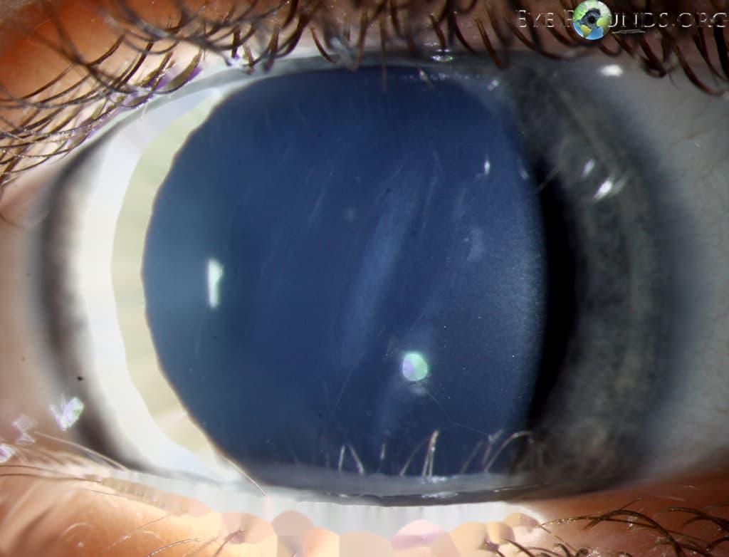 Clinical ophthalmic photograph of descemets membrane rupture secondary to forceps injury - trauma condition