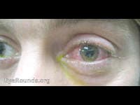 Clinical ophthalmic photograph of traumatic endophthalmitis - trauma condition