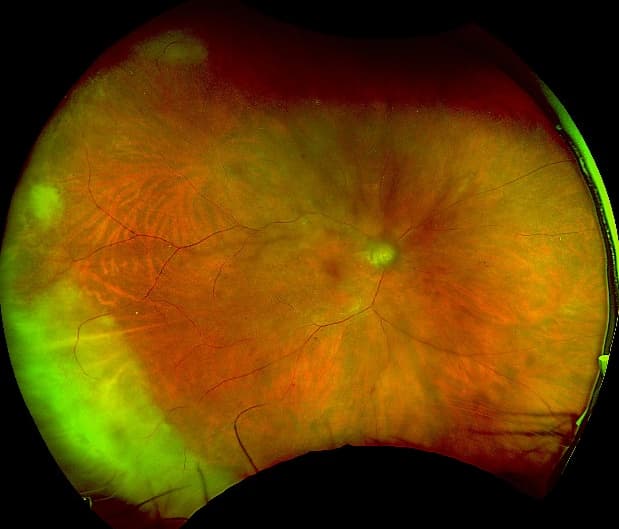 Clinical ophthalmic photograph of acute retinal necrosis - uveitis condition