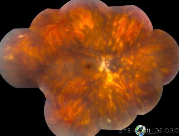 Clinical ophthalmic photograph of birdshot chorioretinopathy - uveitis condition