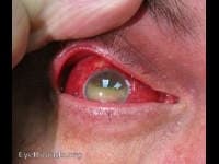 Clinical ophthalmic photograph of endophthalmitis - uveitis condition
