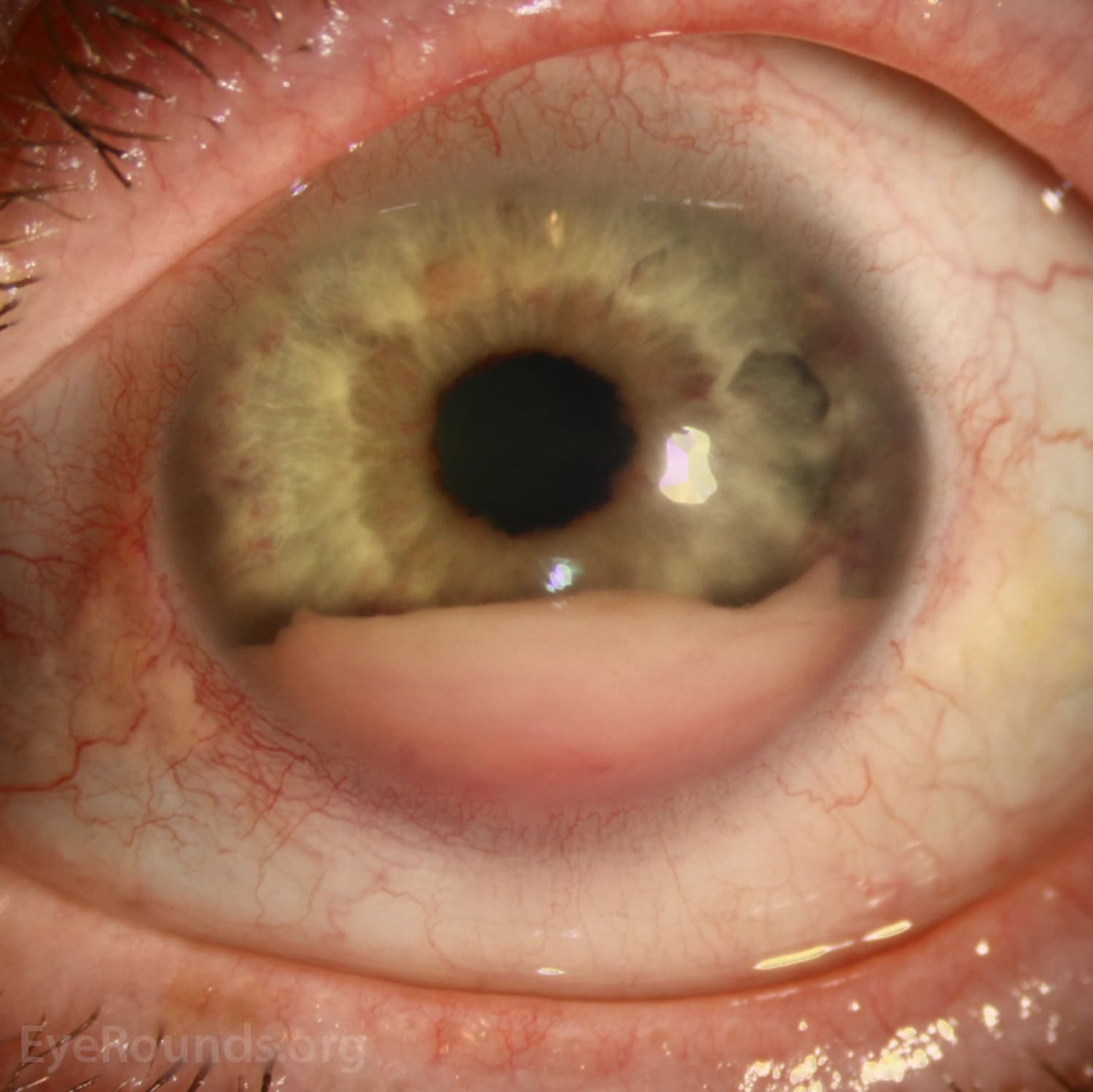 Clinical ophthalmic photograph of leukemic pseudohypopyon - uveitis condition