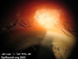 Clinical ophthalmic photograph of madarosis - uveitis condition