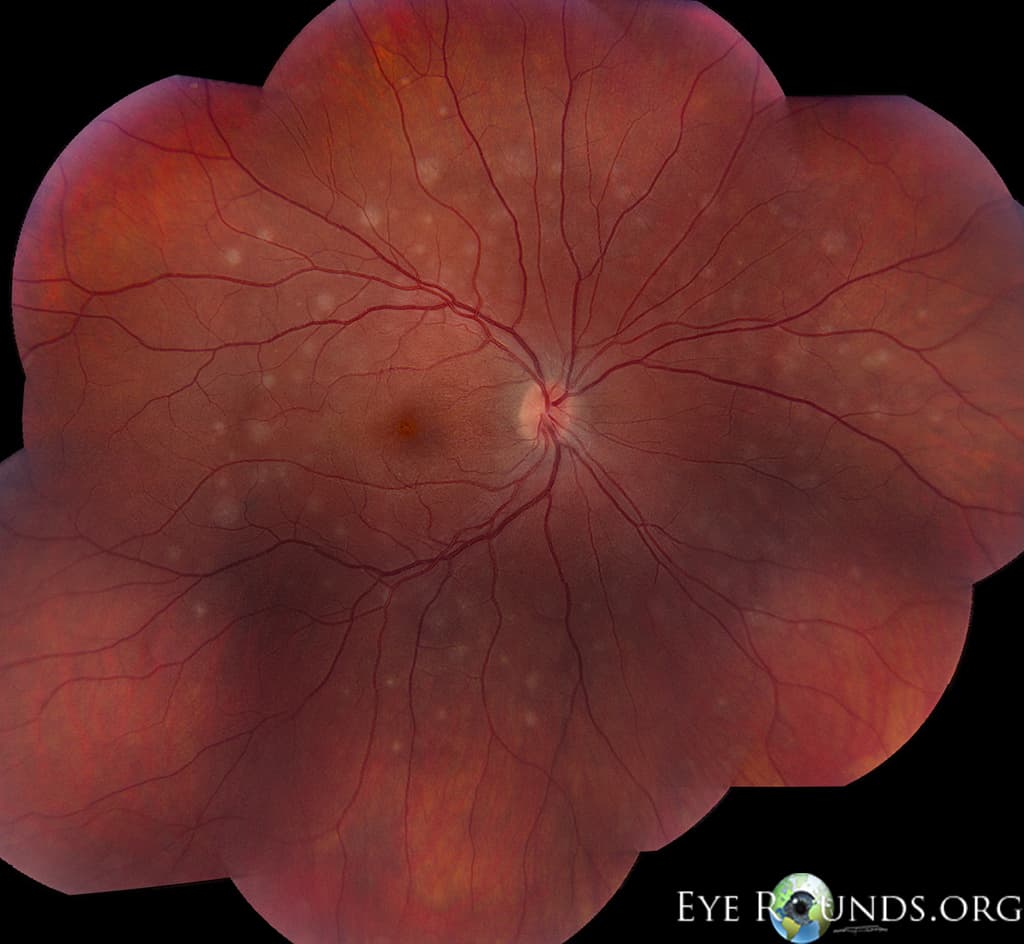 Clinical ophthalmic photograph of multiple evanescent white dot syndrome mewds - uveitis condition