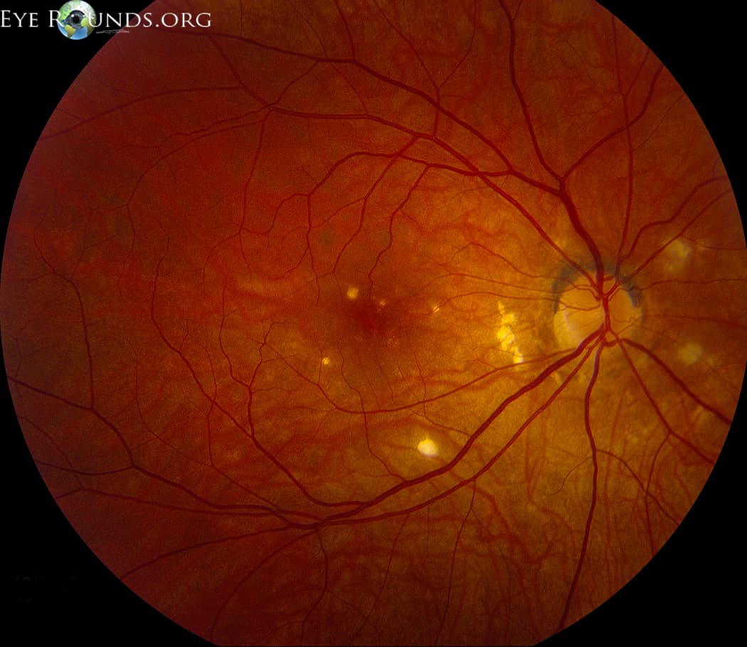 Clinical ophthalmic photograph of punctate inner choroiditis pic - uveitis condition