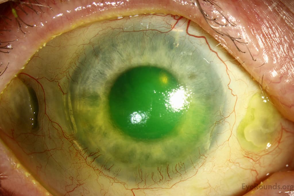 Clinical ophthalmic photograph of scleromalacia in rheumatoid arthritis - uveitis condition