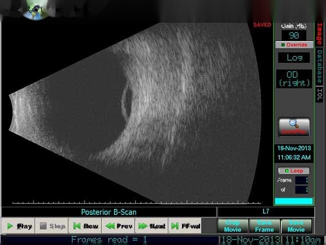 Clinical ophthalmic photograph of acquired peripheral retinoschisis - vitreous condition