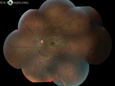 Clinical ophthalmic photograph of allen dots - vitreous condition
