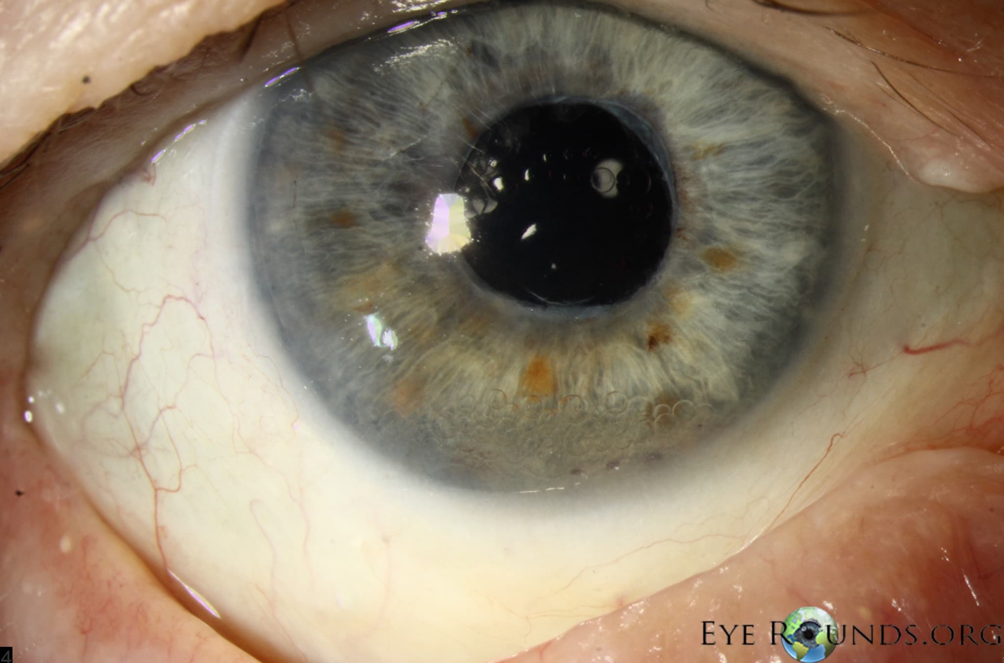 Clinical ophthalmic photograph of anterior chamber perfluoro n octane pfo bubbles - vitreous condition