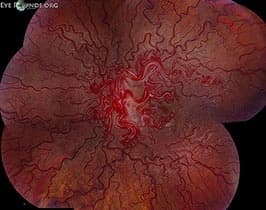Clinical ophthalmic photograph of arteriovenous malformation in wyburn mason syndrome - vitreous condition