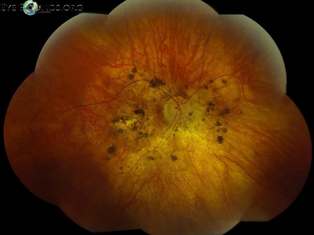Clinical ophthalmic photograph of bardet biedl syndrome - vitreous condition