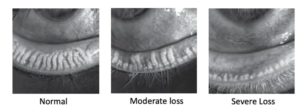 MGDx meibography showing meibomian gland grading from healthy to severe atrophy