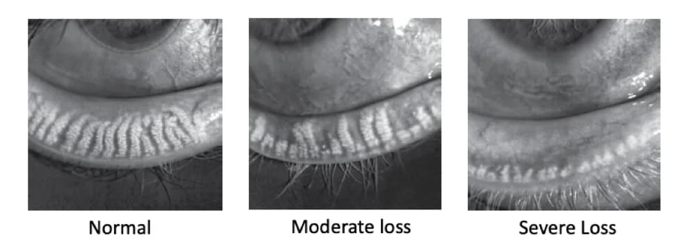 Meibomian gland dysfunction grading scale — showing healthy glands progressing to severe atrophy