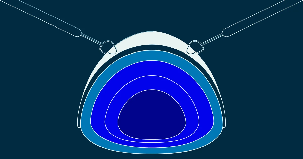 Bowman Layer Onlay Grafting for Advanced Keratoconus