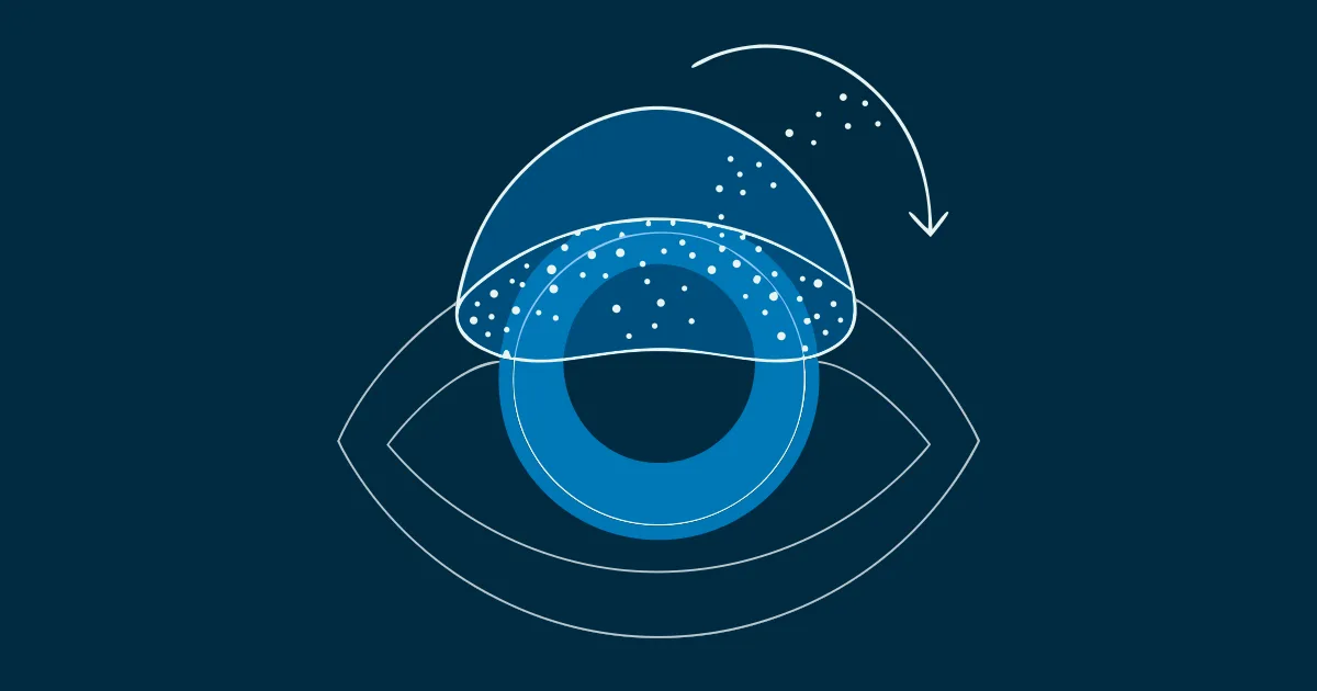 Scleral Lens Fogging: Causes & How to Fix It