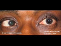 Olfactory Groove Meningioma and Abducens Palsy: Why a Frontal Tumor Causes Double Vision