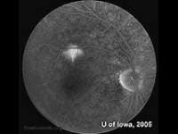 Central Serous Chorioretinopathy: Symptoms, Causes & Treatment in Orange County