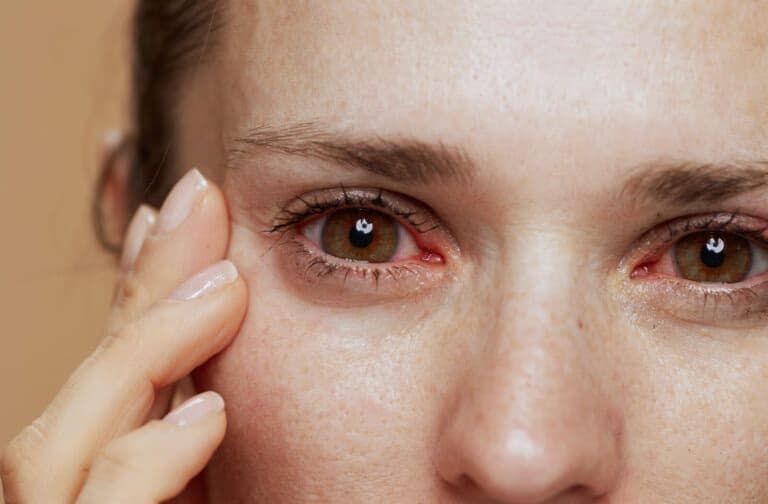 Woman experiencing dry eyes while working at computer screen