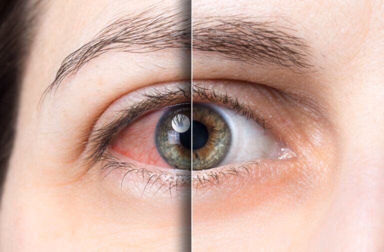 Close-up of an irritated, red eye that needs same-day evaluation