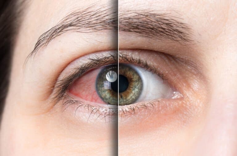 Close-up of an irritated, red eye that needs same-day evaluation