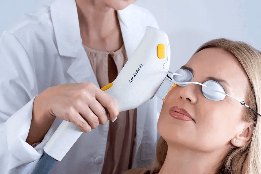 IPL Treatment Process for Dry Eye Relief